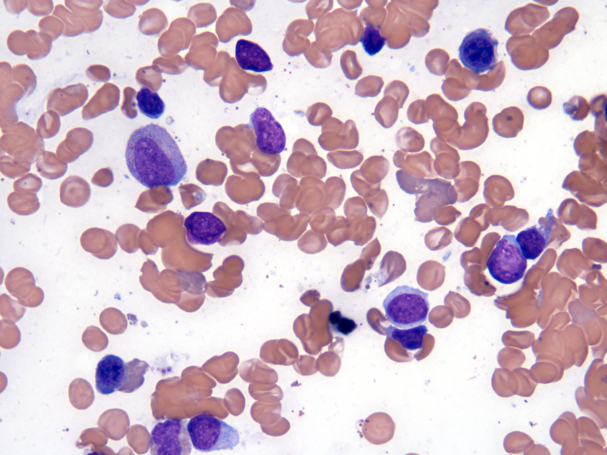 Bone Marrow aspirate_2